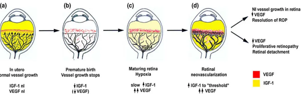 Figura 3.  Meccanismi della retinopatia del prematuro (ROP)  