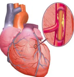 Fig. 1 Immagine dell’occlusione coronarica nel cuore infartuato. 