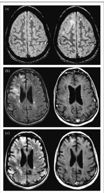 Figura  5:  Progressione  delle  alterazioni  alla  MRI.  Il  riquadro  a  mostra  immagini  ottenute  prima  dello  sviluppo  dei  sintomi  correlati  alla  PML  a  sinistra  una  MRI  assiale  T2  ponderata,  eseguita  nell’ottobre  del  2003  mostra  pi
