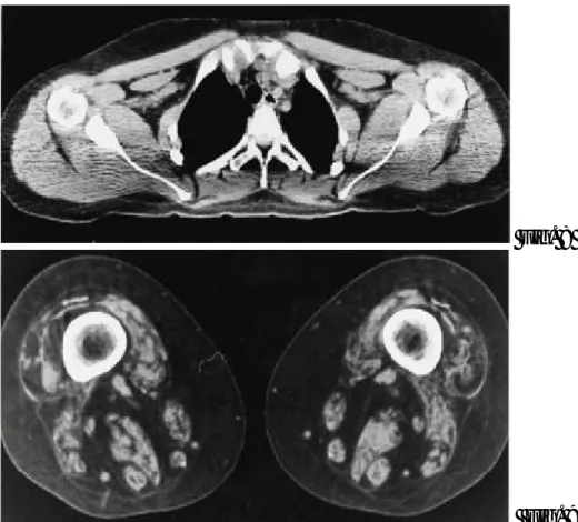 Figura 8: Cingolo scapolare di una donna di 21 anni affetta da neuropatia motoria e sensoriale ereditaria