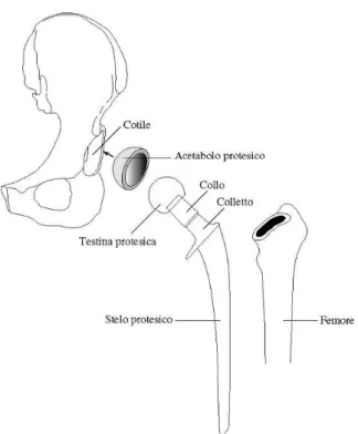 Figura 1.2: Componenti di una protesi d’anca.