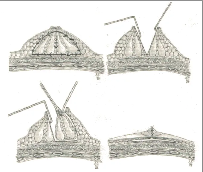 Fig. 4 [53] in alto a sinistra lo schema di resezione della ghiandola in cui in numero crescente si indica l'ordine delle fasi  chirurgiche
