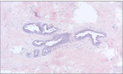 Fig. 15 Reperto di ginecomastia di (P.T) 16 anni. Aree diffuse di fibrosi, edema  periduttale ridotta (colorazione con ematossilina–eosina) 