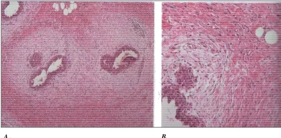 Fig.  2.  Ginecomastia  quiescente.  A:  edema  periduttale  ridotto  B:  iperplasia  epiteliale minima ancora presente 