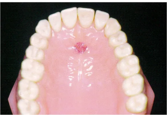 Fig. 11 - La zona marcata in rosso su questa riproduzione dell’arcata dentale superiore corrisponde allo  spot palatino