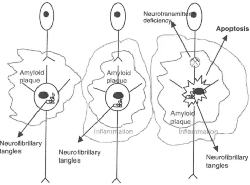 Figura 8-I cambiamenti neuronali in cellule nervose affette da malattia di Alzheimer. Nella fase  precoce (a sinistra) ci sono depositi amiloidi che circondano i neuroni e grovigli neurofibrillari 