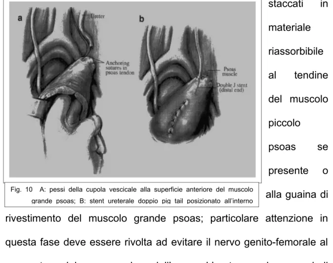 Fig.   10     A:   pessi   della   cupola   vescicale   alla   superficie   anteriore   del   muscolo  grande   psoas;   B:   stent   ureterale   doppio   pig   tail   posizionato   all’interno 