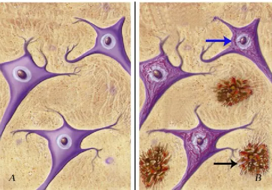 Figura  1.1:  placche  e  grovigli.  A)  Neuroni  in  un  cervello  di  un  paziente  sano