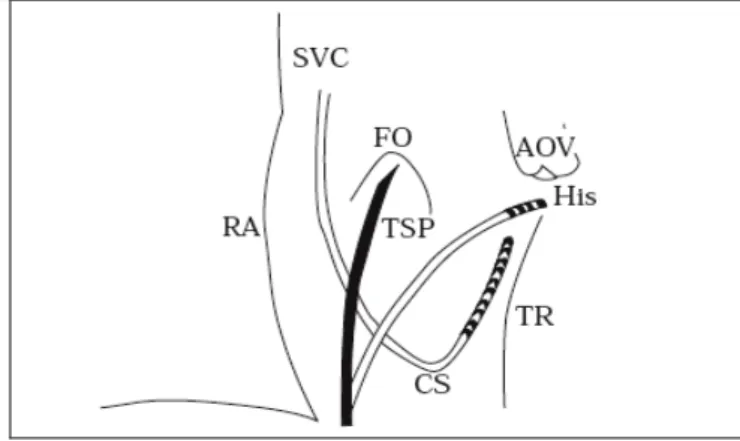 Figura  4. .SVC:  vena  cava  superiore,;  FO:  fossa  ovale;  AOV  valvola  aortica;  RA:  parete  dell’atrio  destro;  TSP:  sistema  di  introduzione;  His:  area  del  fascio  di  His;  TR:  anello  tricuspidale; CS: seno coronario