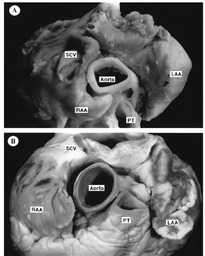 Figura n.8. La base del cuore di suino (A) e di uomo (B). RAA (right atrial appendage) = orecchietta dell'atrio  destro;  LAA(left  atrial  appendage)  =  orecchietta  dell'atrio  sinistro;  SCV  (superior  caval  vein)=  vena  cava  superiore; PT(pumonary