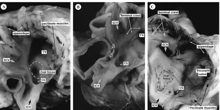 Figura  n.11.  Cavità  dell'atrio  destro  di  suino  (A,B)  e  uomo  (C)  dopo  incisione  dell'auricola  destra
