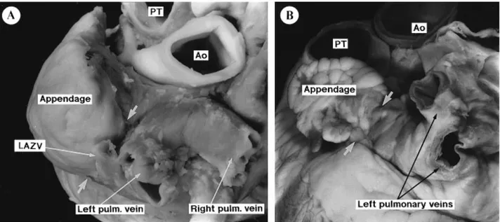 Figura  n.12  Aspetto  esterno  dell'atrio  sinistro  di  suino  (A),  di  uomo  (B).  PT  (polmonary  trunk)  =  tronco  polmonare; Ao = aorta; LAZV (left azigos vein) = vena azigos sinistra