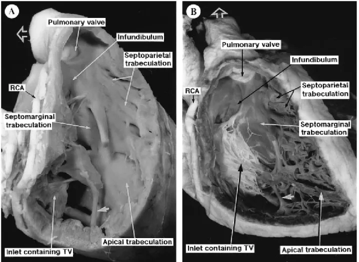 Figura n.14 La struttura interna del ventricolo destro di suino (A) e di uomo (B). RCA (righy coronary artery)  = arteria coronaria destra; la punta della freccia indica la trabecola settomarginale; la freccia aperta indica la  direzione del tronco polmona