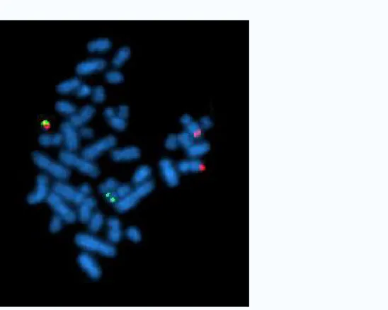 Figura 12- Una cellula in metafase positiva per BCR-ABL - 