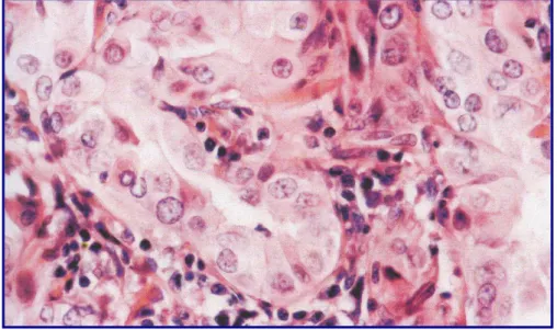 Figura N°3: carcinoma papillare variante a cellule alte 