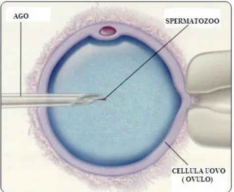 Figura 3 tecnica ICSI (modificata da Centro Ricerca Medicina della Riproduzione) 