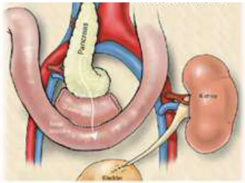 Figura 1.2: Trapianto di pancreas con drenaggio sistemico-enterico. 