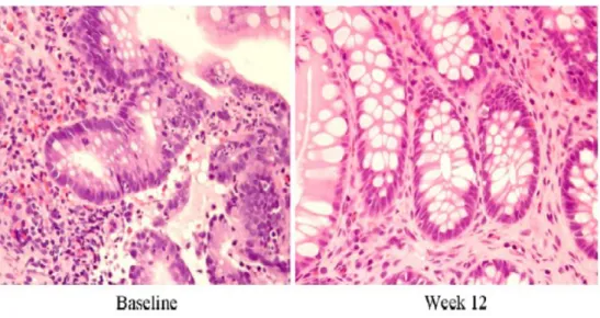 Figura  6.  Istologia  della  mucosa  del  colon:  prima  del  trattamento  di  aferesi 