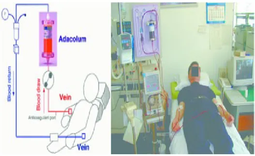 Figura 1. illustrazione di una seduta di granulocitomonocito-aferesi.