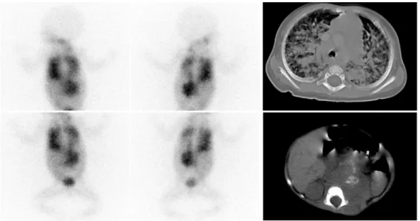 Figura   7.  Paz   DB.   A   sinistra   scintigrafia   con   [ 123 I]MIBG,   a   destra   TC  polmone   e   addome