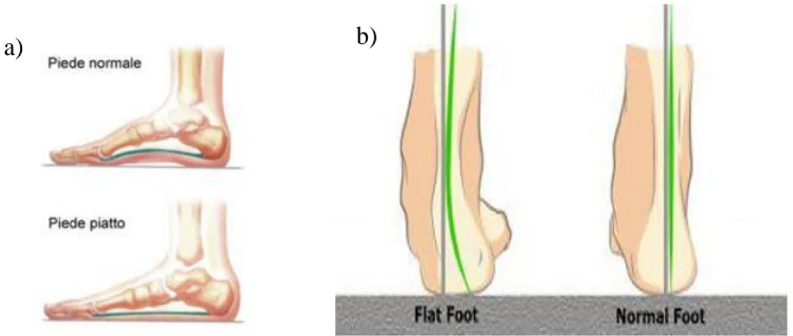 Figura 17: a) Confronto arco interno fra un piede sano e un piede piatto. b) pronazione del calcagno e 
