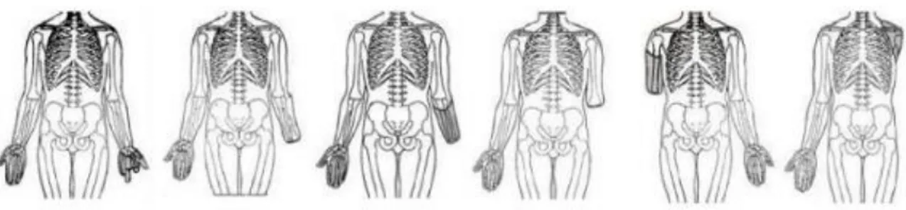Fig. 5 Livelli di amputazione dell’arto superiore, da sinistra 03, 06, 09, 12, 15, 18 