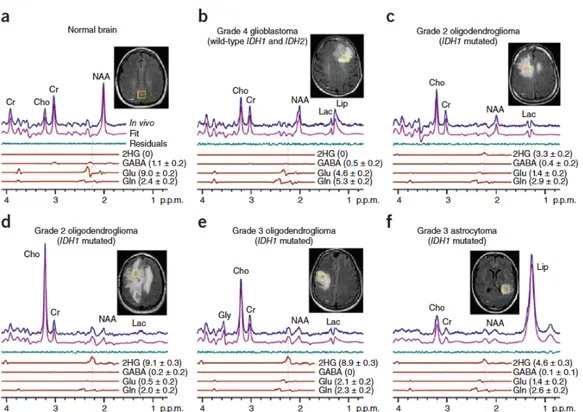 Figura 3.3: Spettri acquisiti in vivo a 3 T con relativa immagine che mostra la localizza- localizza-zione del voxel (2x2x2 cm3) in (a) un cervello sano e in (b-f) tumori cerebrali a diversi stadi