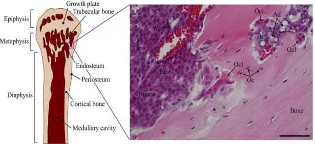Figura 1.10: Tessuto osseo metastatico. 