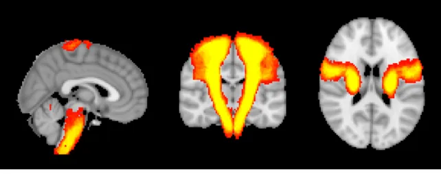 Figura 4.4: Mappa di variabilità del tratto cortico-spinale visualizzata con FSLeyes sui tre piani (da sinistra a destra): sagittale, coronale, assiale