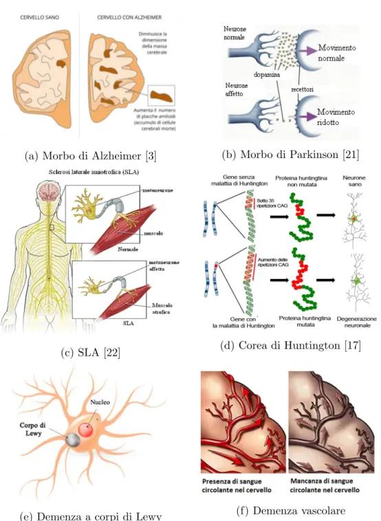Figura 1.1: Rappresentazioni grafiche di come le malattie neurodegenerative pi` u conosciute intaccano il corpo umano.