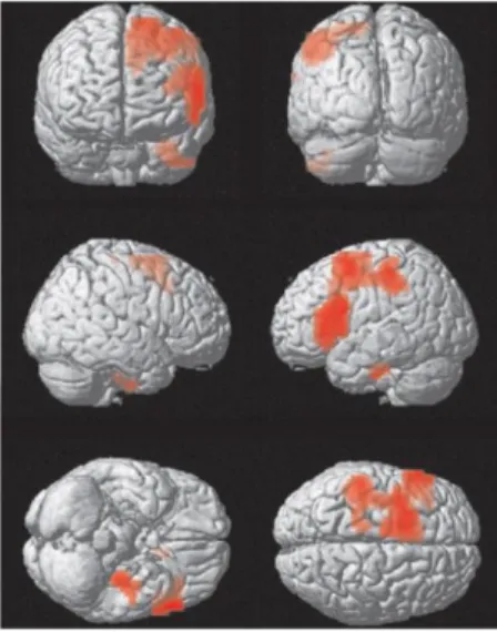 Figura 7. Attivazione delle aree cerebrali durante l’IS dal finlandese in inglese rispetto allo shadowing in  finlandese (Tommola et al., 2000: 159) 