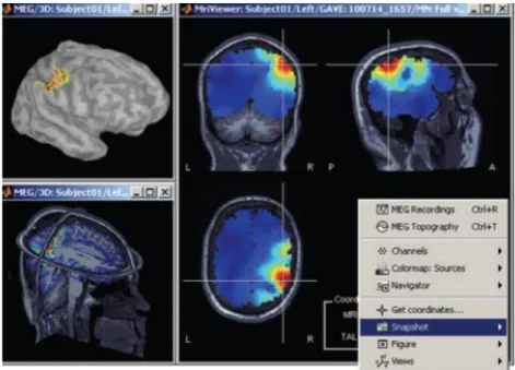 Figura 15: Varie opzioni per visualizzare le sorgenti stimate: interpretazione 3D della  superficie corticale (in alto a sinistra), piani ortogonali 3D dei volumi MRI (in basso a  sinistra) e convenzionale rappresentazione delle tre visioni ortogonali del 