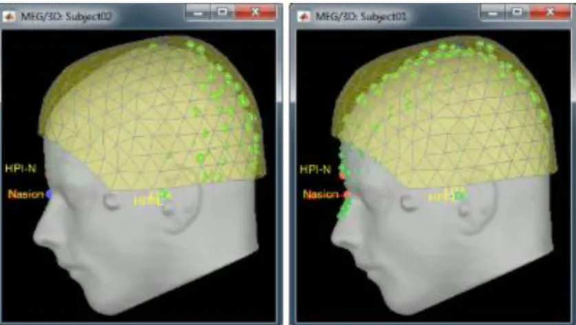 Figura 22: Registrazione prima (a sinistra) e dopo (a destra) la registrazione automatica  della sagoma della testa