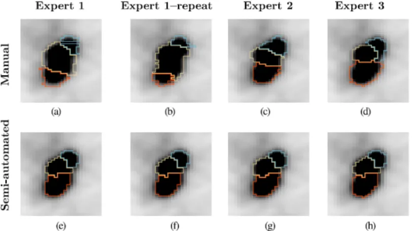 Figure 1.7: Comparison between manual slice-to-slice segmentation and graph based segmen-