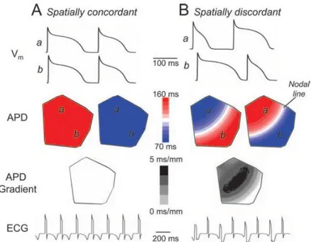 Figura 2.1: Alternans concordanti (A) e discordanti (B). In alto vengono mostrati gli APs simulati in due 