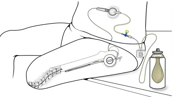 Figura VI – Sistema di infusione continua mediante pompa elastomerica.  