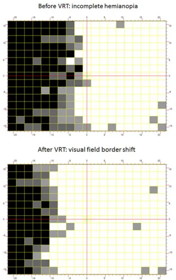 Fig. 5. Campimetria computerizzata pre e post-trattamento di paziente sottoposto a VRT [24]