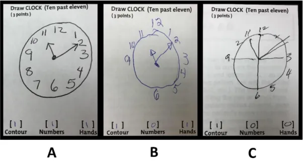 Figure 1 – An example of the Clock-Drawing Task, a subtest of the Trail Making Test, performed by                                                                        v                   a CTR subject (A - 3 points), a PD subject with mild cognitive impa