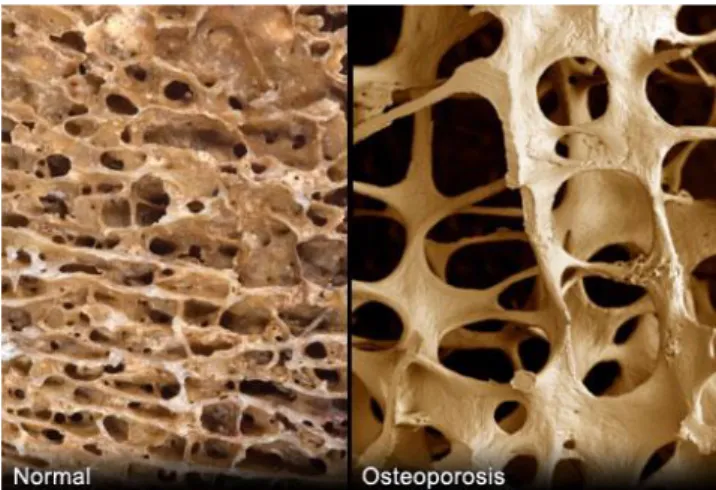 Figura 1.5 - Differenze qualitative fra osso trabecolare sano (a  sinistra) e osteoporotico (a destra) 