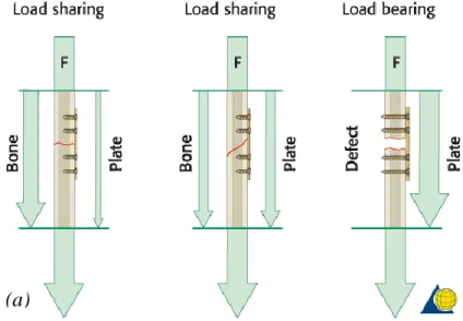 Figure 1.11 – (a) In a load-sharing situation, bone assumes most of the functional load; (b)  treatment of a defect fracture, in which the osteosynthesis assumes all the masticatory loads