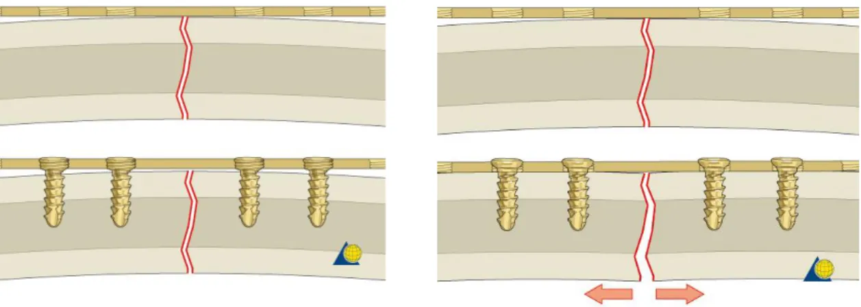 Figure 1.13 – Malreduction due to screw tightening of a nonlocking plate. 