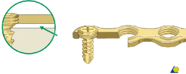 Figure 1.14 – In locking systems the screw head is fixed to the plate. 