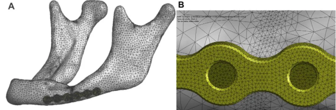 Figure 1.16 – 3D model of a fractured atrophic mandible and a reconstruction plate 2.0
