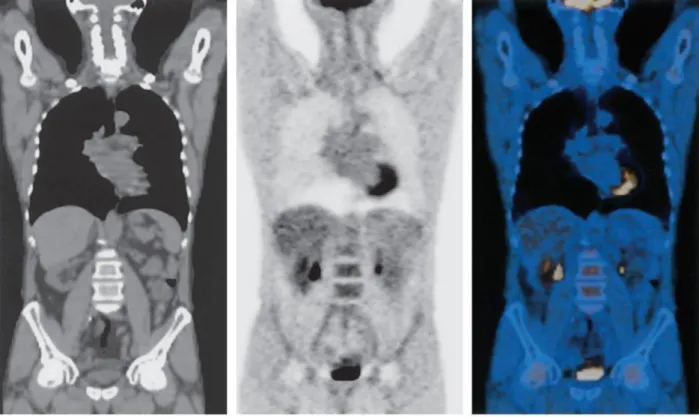 Figura 1. Confronto tra immagini ottenute per mezzo di diverse tecniche. L’immagine a sinistra è una CT, l’immagine al centro è una  PET e l’immagine a destra una PET-CT fusion