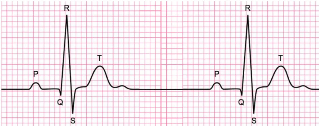 Figura  1.8.  Esempio  di  tracciato  ECG  in  derivazione  D1.  Sono  evidenti  le  onde  e  i  complessi canonici P, QRS, T e le fasi isoelettriche (tratta da [16]) 