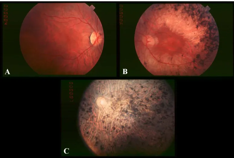 Figura 2.9 – Immagini retinografiche relative al decorso della retinite  pigmentosa. Stadi iniziale (A), intermedio (B) e finale (C): sono evidenti il 