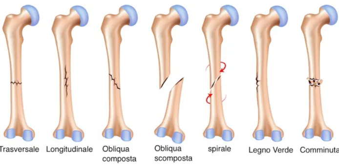 Fig 1.5 Tipi di frattura