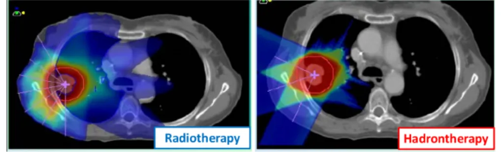 Figure 1.9: A comparison between the radio (at left) and the hadron-therapy (at right)