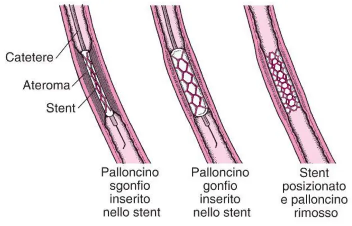 Figura 4 - Angiografia coronarica