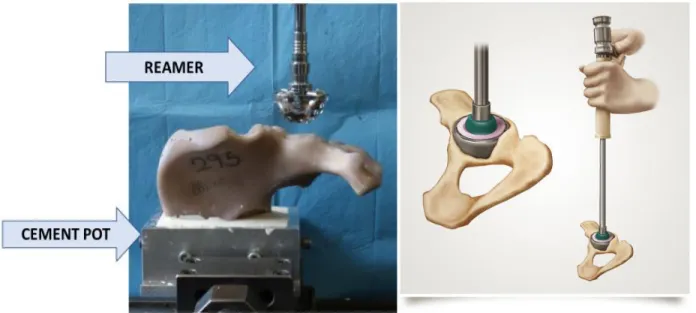 Fig. 45: Left: Hemipelvis aligned into the pot and surgical reamer perpendicular to the  acetabulum